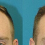 FUE NeoGraft Hair Transplant #8 - Before and After