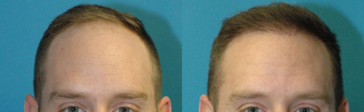 FUE NeoGraft Hair Transplant #8 - Before and After