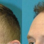 FUE NeoGraft Hair Transplant #8 - Before and After