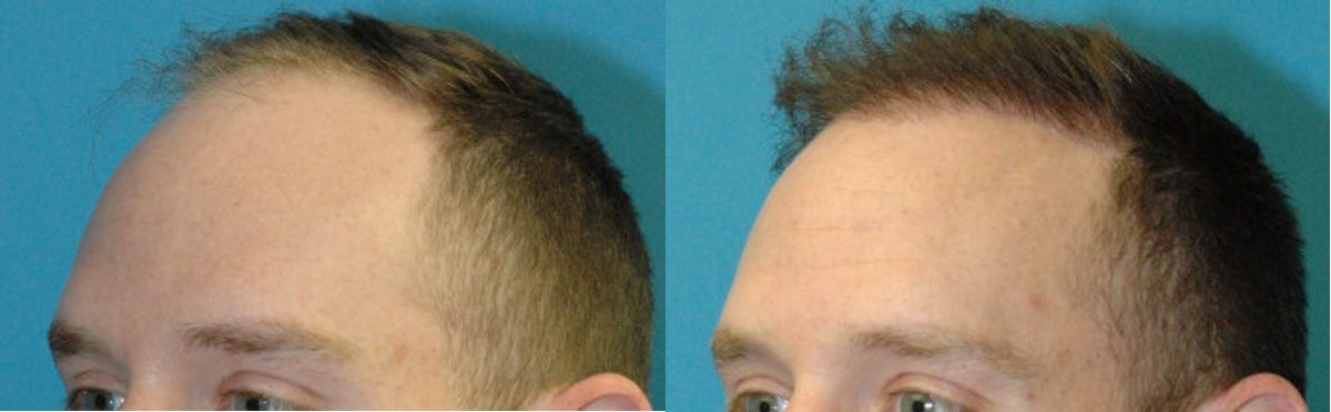 FUE NeoGraft Hair Transplant #8 - Before and After