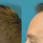 FUE NeoGraft Hair Transplant #8 - Before and After
