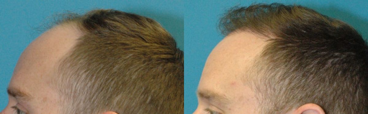 FUE NeoGraft Hair Transplant #8 - Before and After