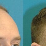 FUE NeoGraft Hair Transplant #8 - Before and After