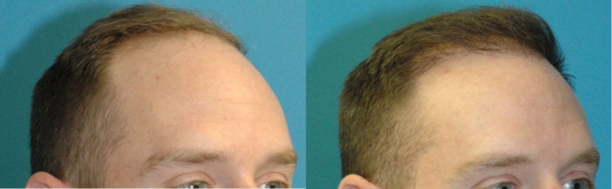 FUE NeoGraft Hair Transplant #8 - Before and After