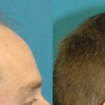 FUE NeoGraft Hair Transplant #8 - Before and After