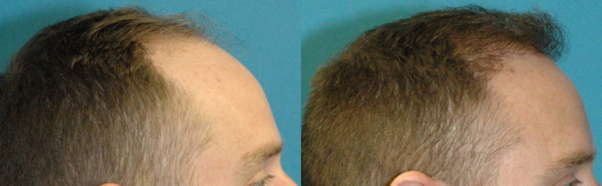 FUE NeoGraft Hair Transplant #8 - Before and After