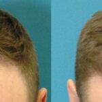 FUE NeoGraft Hair Transplant #8 - Before and After