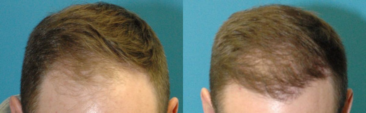 FUE NeoGraft Hair Transplant #8 - Before and After
