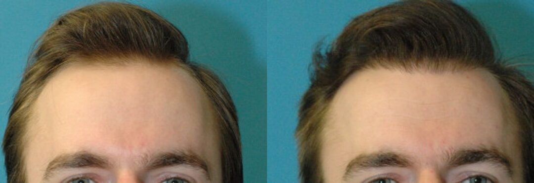 FUE NeoGraft Hair Transplant #9