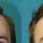 FUE NeoGraft Hair Transplant #9 - Before and After