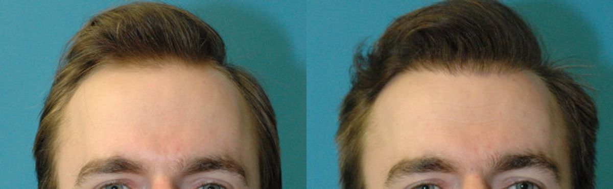 FUE NeoGraft Hair Transplant #9 - Before and After