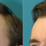 FUE NeoGraft Hair Transplant #9 - Before and After