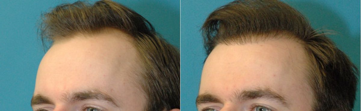 FUE NeoGraft Hair Transplant #9 - Before and After