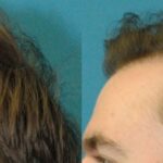 FUE NeoGraft Hair Transplant #9 - Before and After
