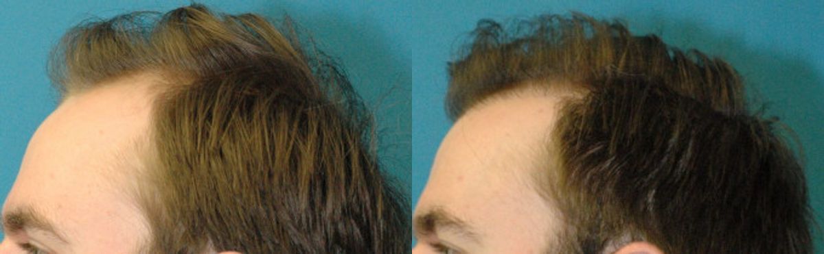 FUE NeoGraft Hair Transplant #9 - Before and After