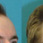 FUE NeoGraft Hair Transplant #9 - Before and After