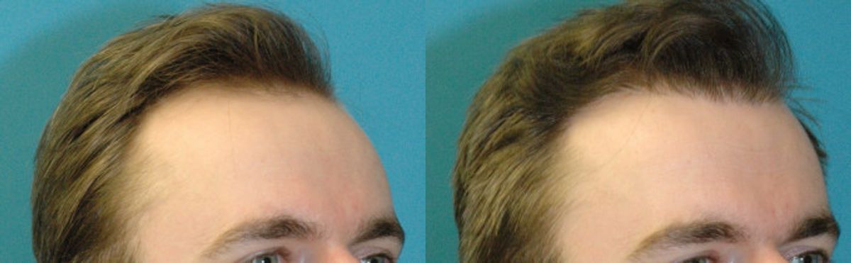 FUE NeoGraft Hair Transplant #9 - Before and After