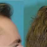 FUE NeoGraft Hair Transplant #9 - Before and After