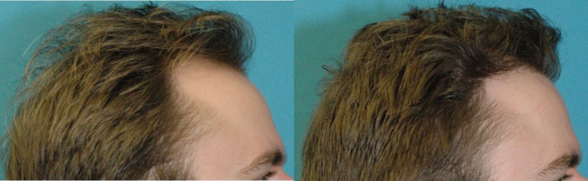 FUE NeoGraft Hair Transplant #9 - Before and After