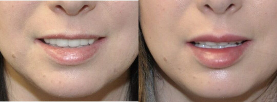 Juvederm for Lips #1