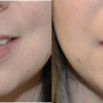 Juvederm for Lips #1 - Before and After