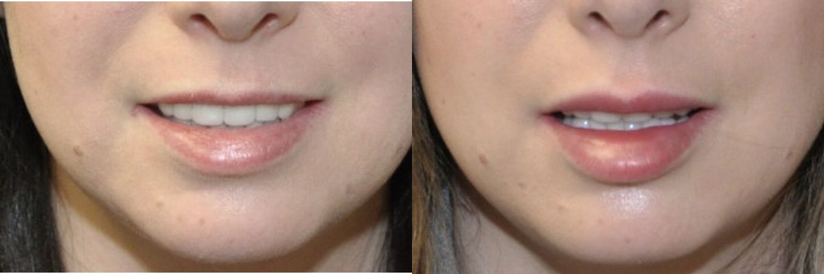 Juvederm for Lips #1 - Before and After