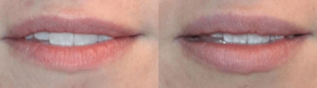 Juvederm for Lips #3