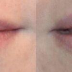 Juvederm for Lips #3 - Before and After