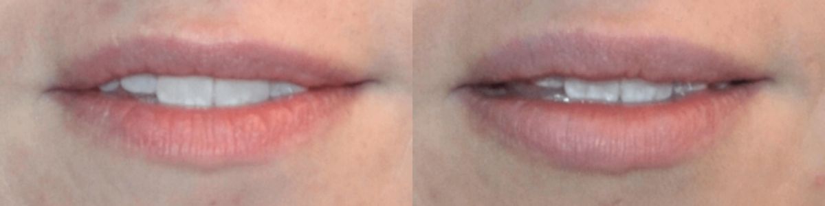 Juvederm for Lips #3 - Before and After