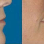 Juvederm for Lips #3 - Before and After