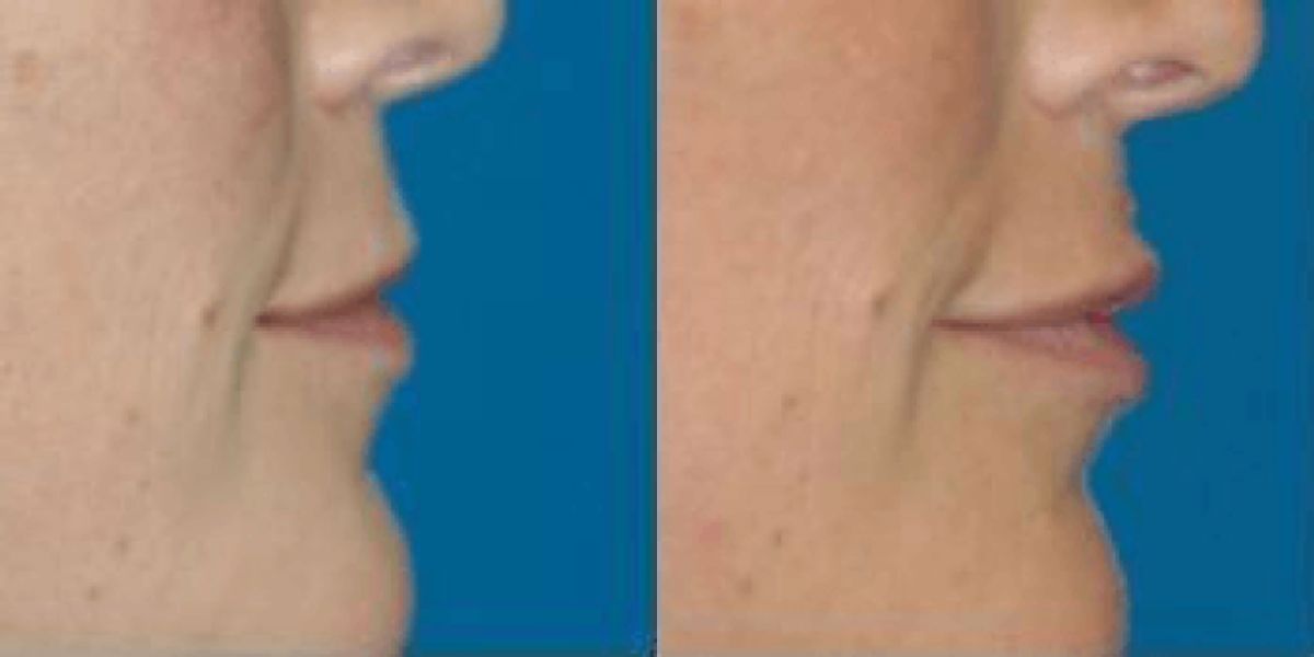 Juvederm for Lips #3 - Before and After