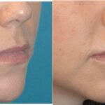 Juvederm for Lips #3 - Before and After