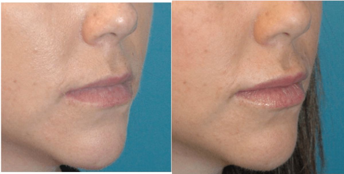 Juvederm for Lips #3 - Before and After