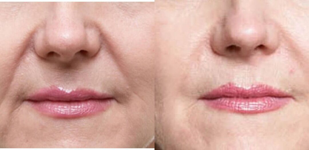 Juvederm for Nasal Labial Folds