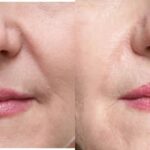 Juvederm for Nasal Labial Folds - Before and After
