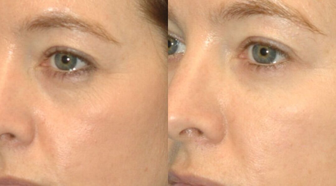 Juvederm for Tear Troughs #1