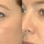 Juvederm for Tear Troughs #1 - Before and After