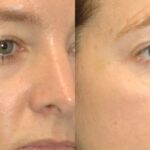 Juvederm for Tear Troughs #1 - Before and After