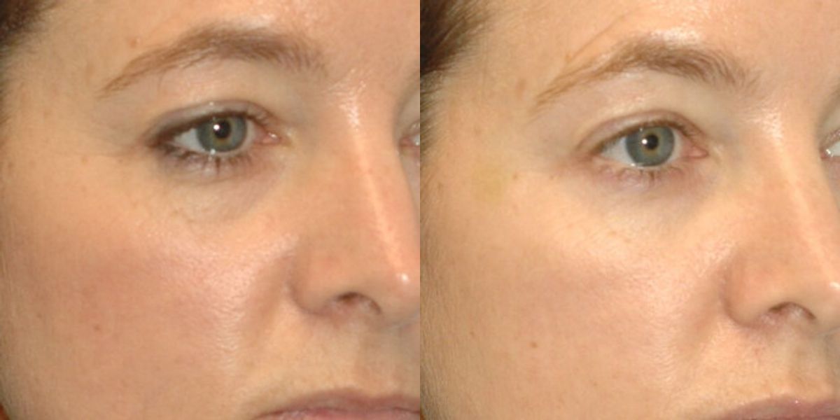Juvederm for Tear Troughs #1 - Before and After