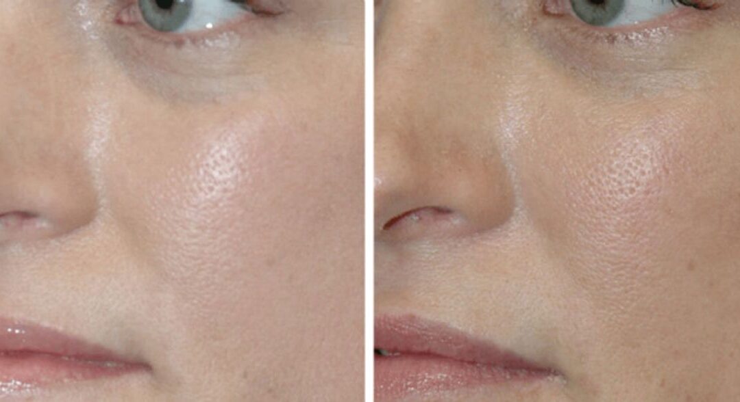 Juvederm for Tear Troughs #2