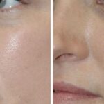 Juvederm for Tear Troughs #2 - Before and After