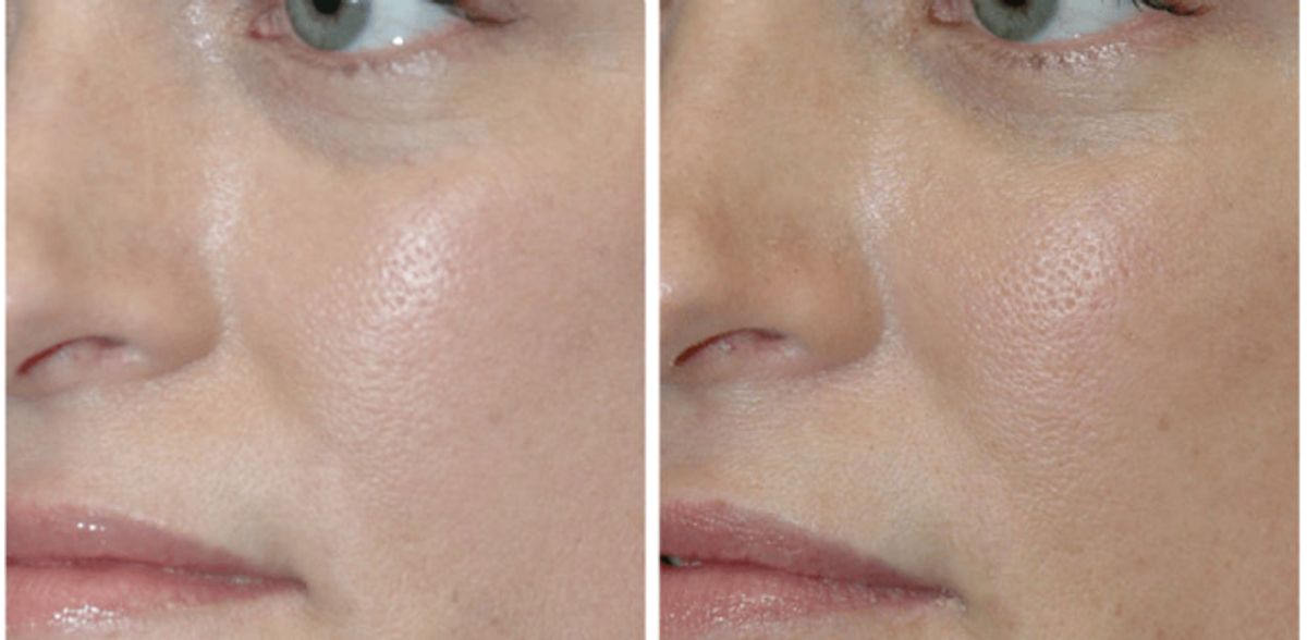 Office Reception Area Image Juvederm for Tear Troughs #2 - Before and After