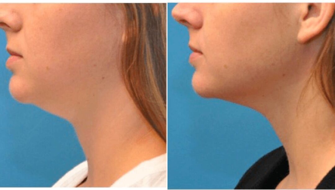 Kybella Treatment