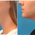 Kybella Treatment - Before and After