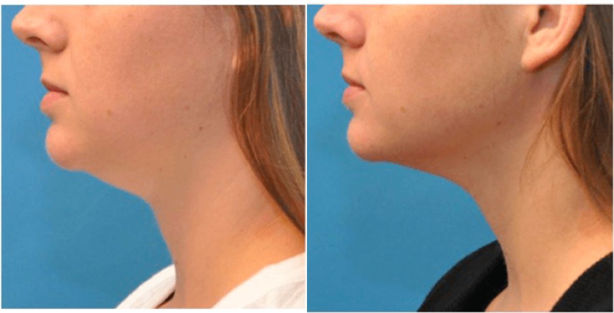 Kybella Treatment - Before and After