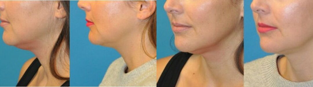 Kybella Treatment #1