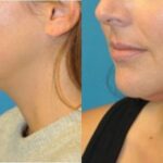 Kybella Treatment #2 - Before and After