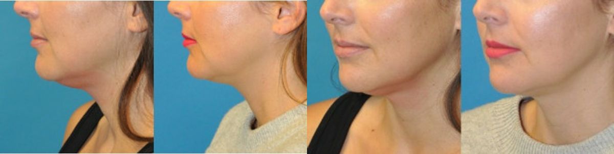 Kybella Treatment #2 - Before and After