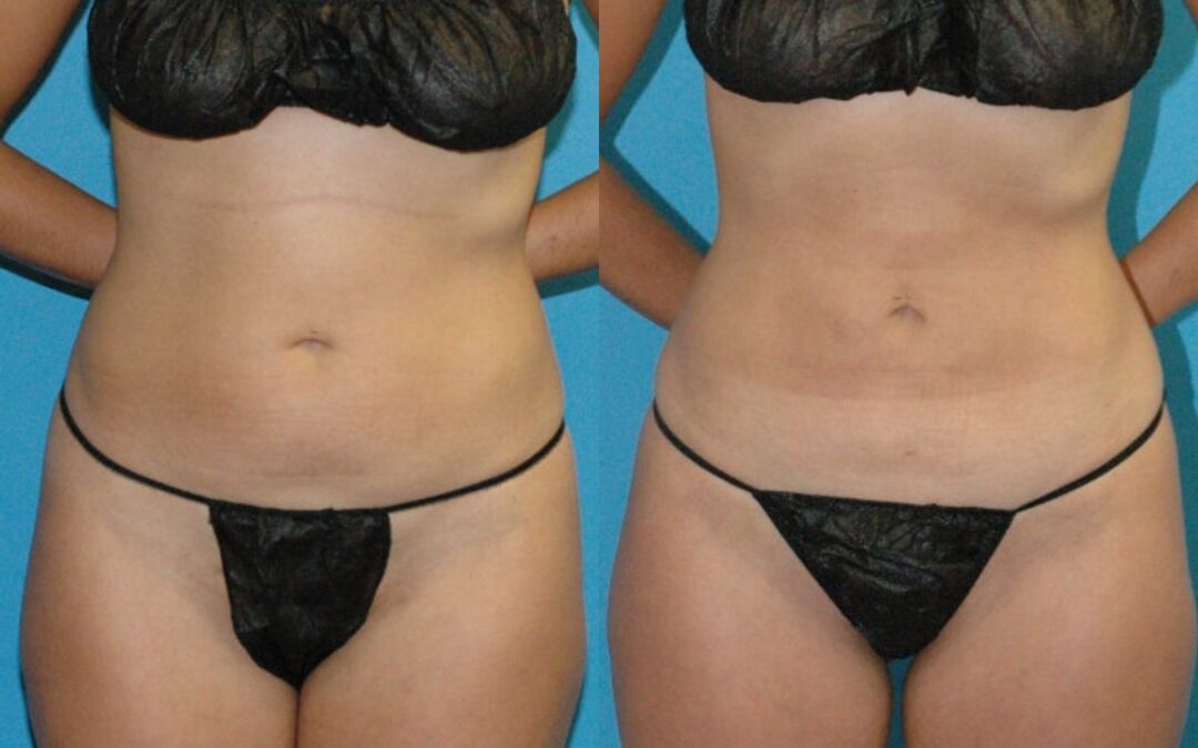 Liposuction #1