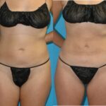 Liposuction #1 - Before and After